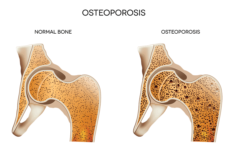 Osteoporosis-Hip-Pain-Pain-Treatment-Specialists